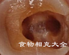 龋齿的病人能吃辛辣刺激食物吗？