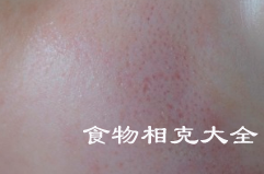 痤疮的病人能吃发物吗？